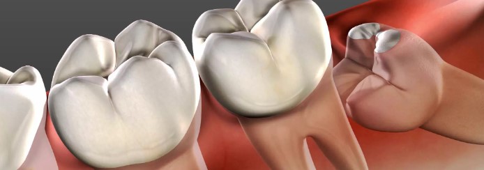 Should You Get Your Wisdom Teeth Extracted?