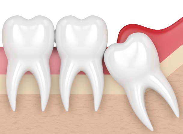 Should You Get Your Wisdom Teeth Extracted, wisdom tooth extraction, dental extraction decision, wisdom teeth removal, oral surgery choice, extraction necessity, dental procedure evaluation, extracting wisdom molars, tooth removal consideration, dental health decision, oral care evaluation, wisdom tooth surgery, oral surgeon consultation, dental extraction recommendation, tooth removal advisement, oral health assessment, wisdom tooth evaluation, dental procedure necessity, extracting molars, oral surgery recommendation, dental health assessment, wisdom tooth removal, oral care evaluation, dental extraction decision